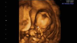 Ecografia 16 semanas 4D y 2D Ultrasound Irati [upl. by Dnomrej]